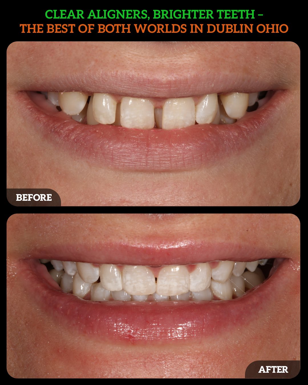 invisalign dublin ohio