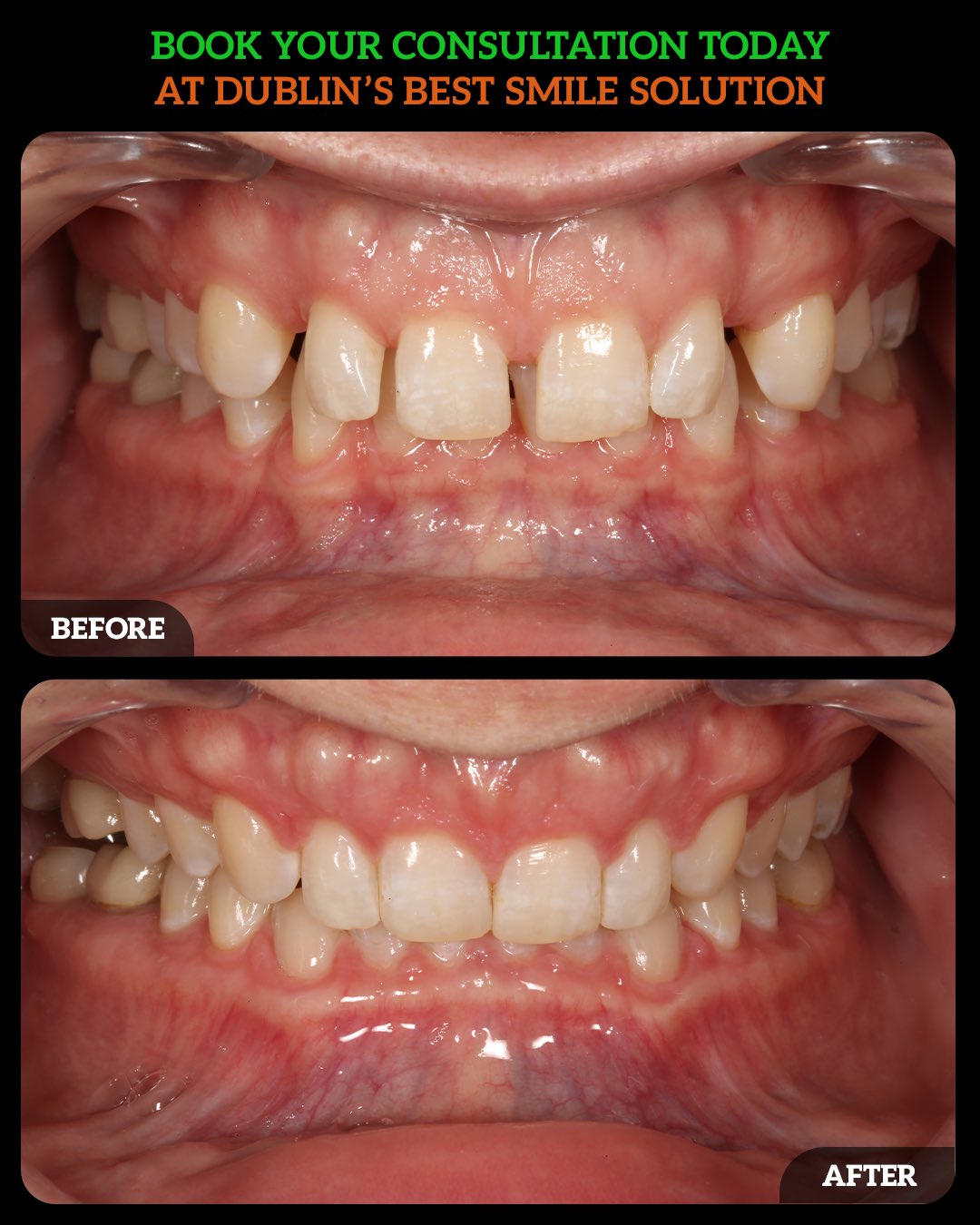 invisalign dublin ohio2