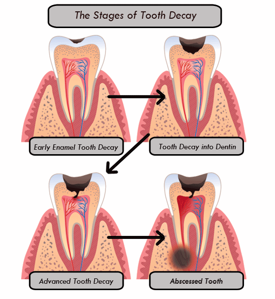 What Is Tooth Decay?
